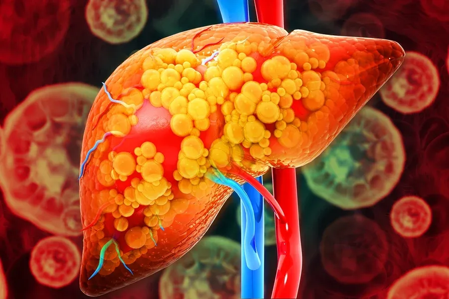 Hepatologista lista os 6 principais sintomas de gordura no fígado
